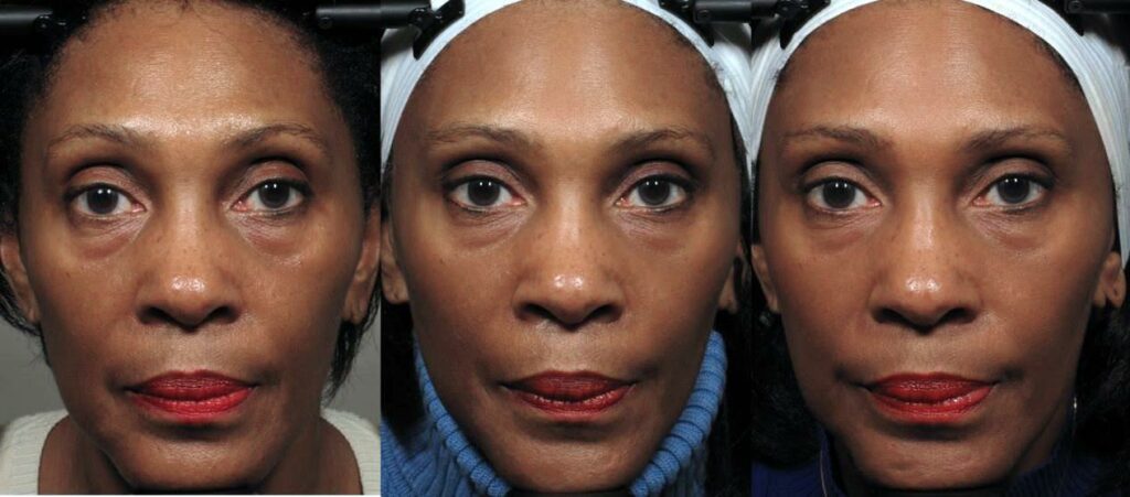 The Secret to Looking Younger Without Surgery