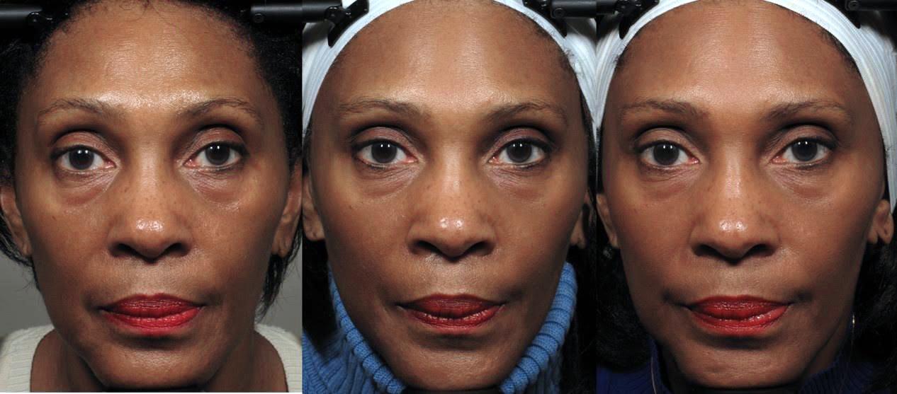 The Secret to Looking Younger Without Surgery